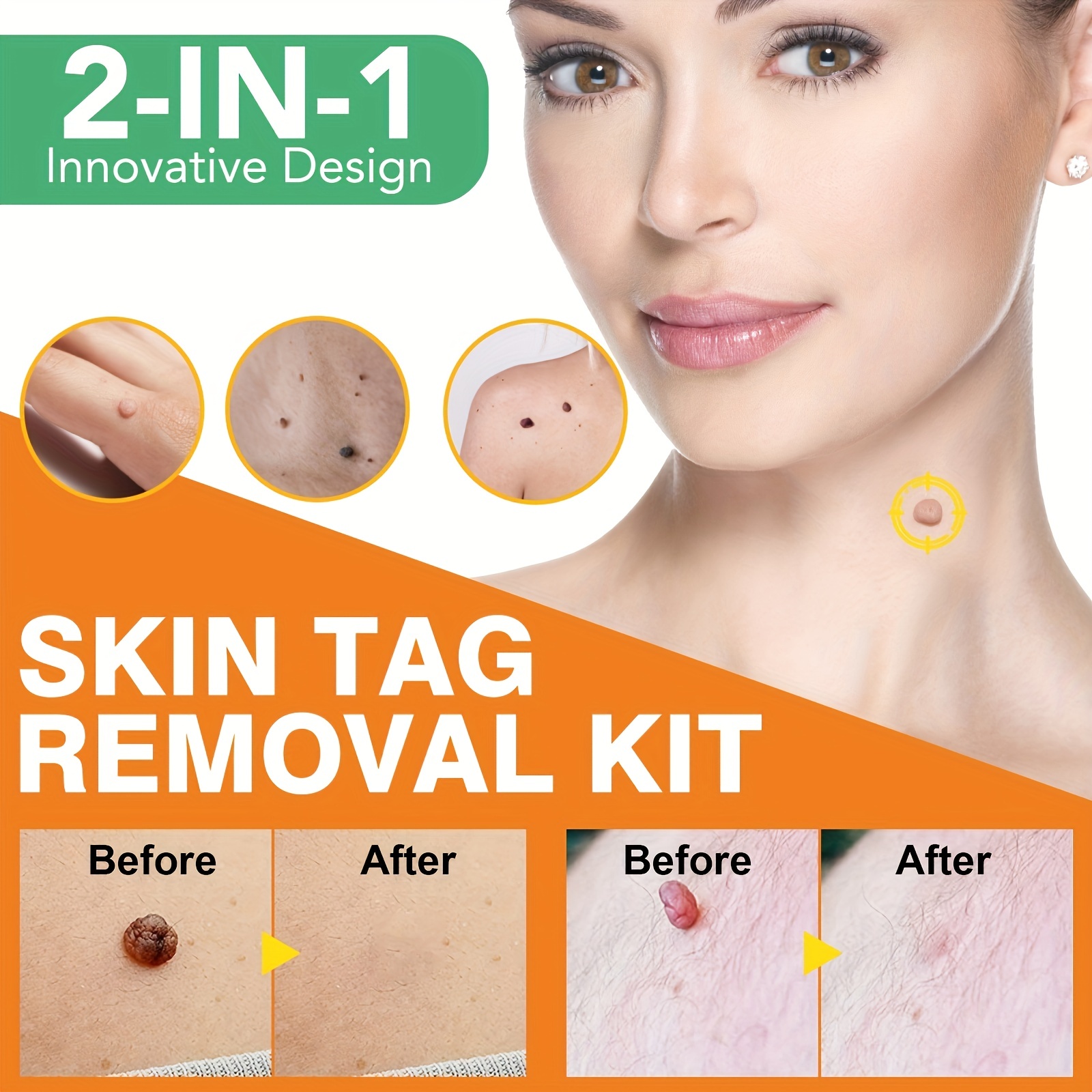 2 IN 1 Wart Removal Kit with Sticker